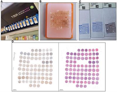 Comparative analysis of GOLPH3 expression in lymph node-positive prostate cancer: immunohistochemistry staining patterns and clinical significance